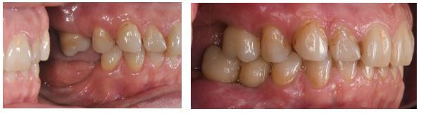 Complexe verticale augmentaties